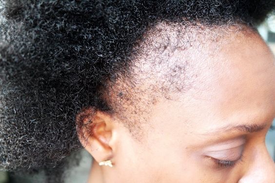 Carence en vitamine D
Carence cheveux crépus 